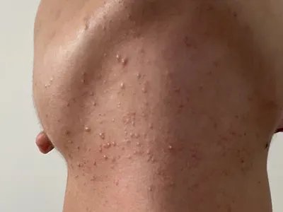 毛囊炎疙瘩图片