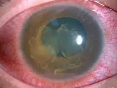 红眼病眼部症状图片