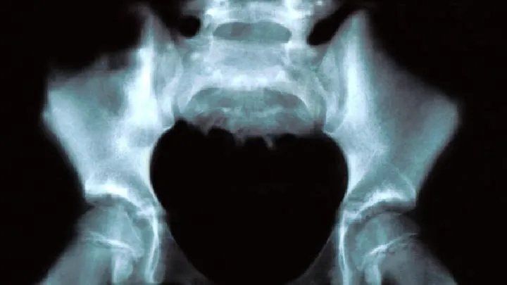 坐骨神经痛的原因