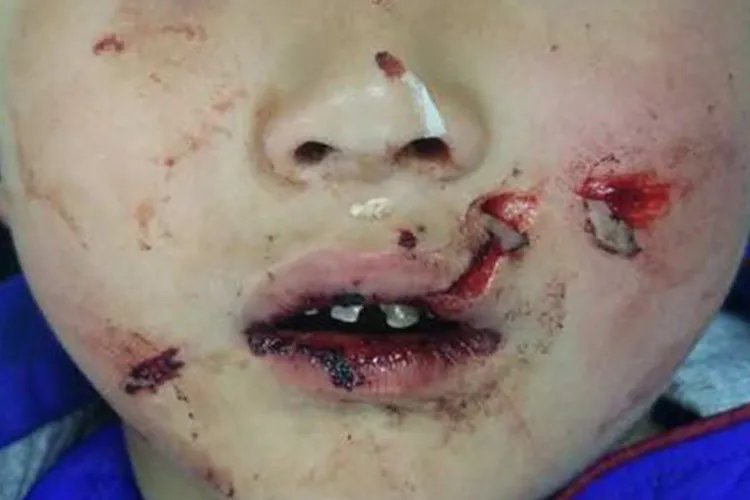 自毁容貌症患者图片