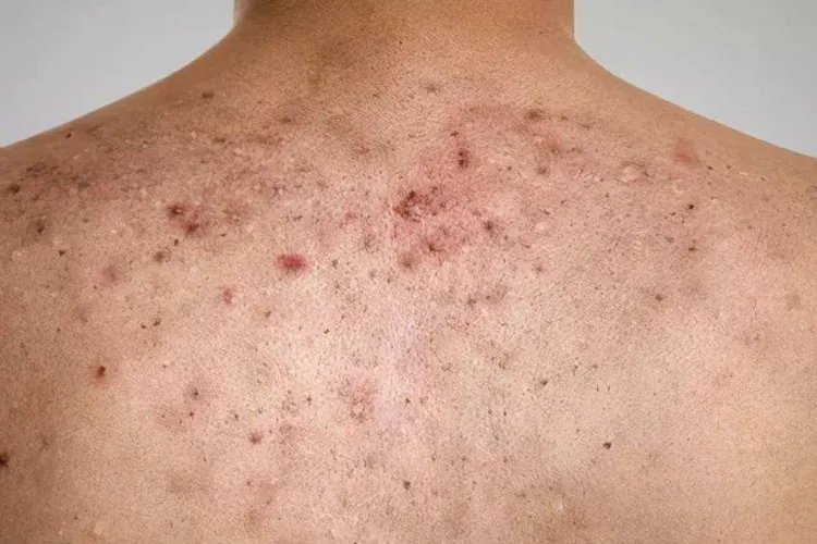 男人后背长痘痘图片