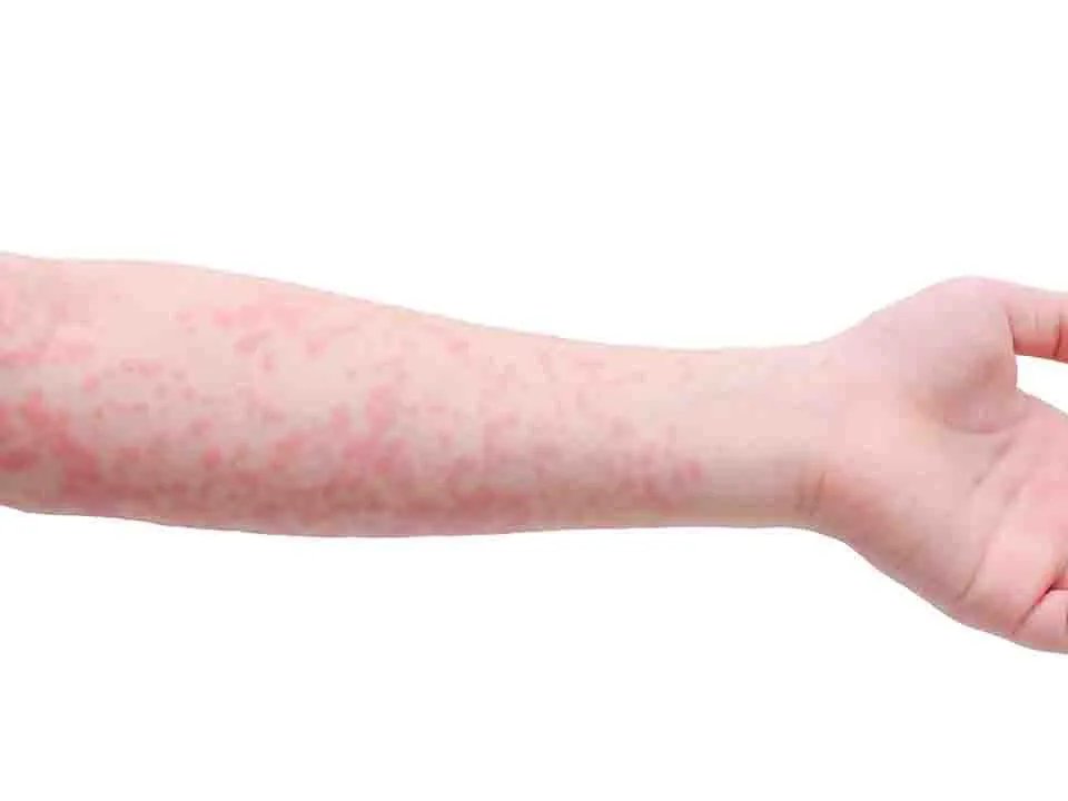 荨麻疹最佳治疗方法有哪些