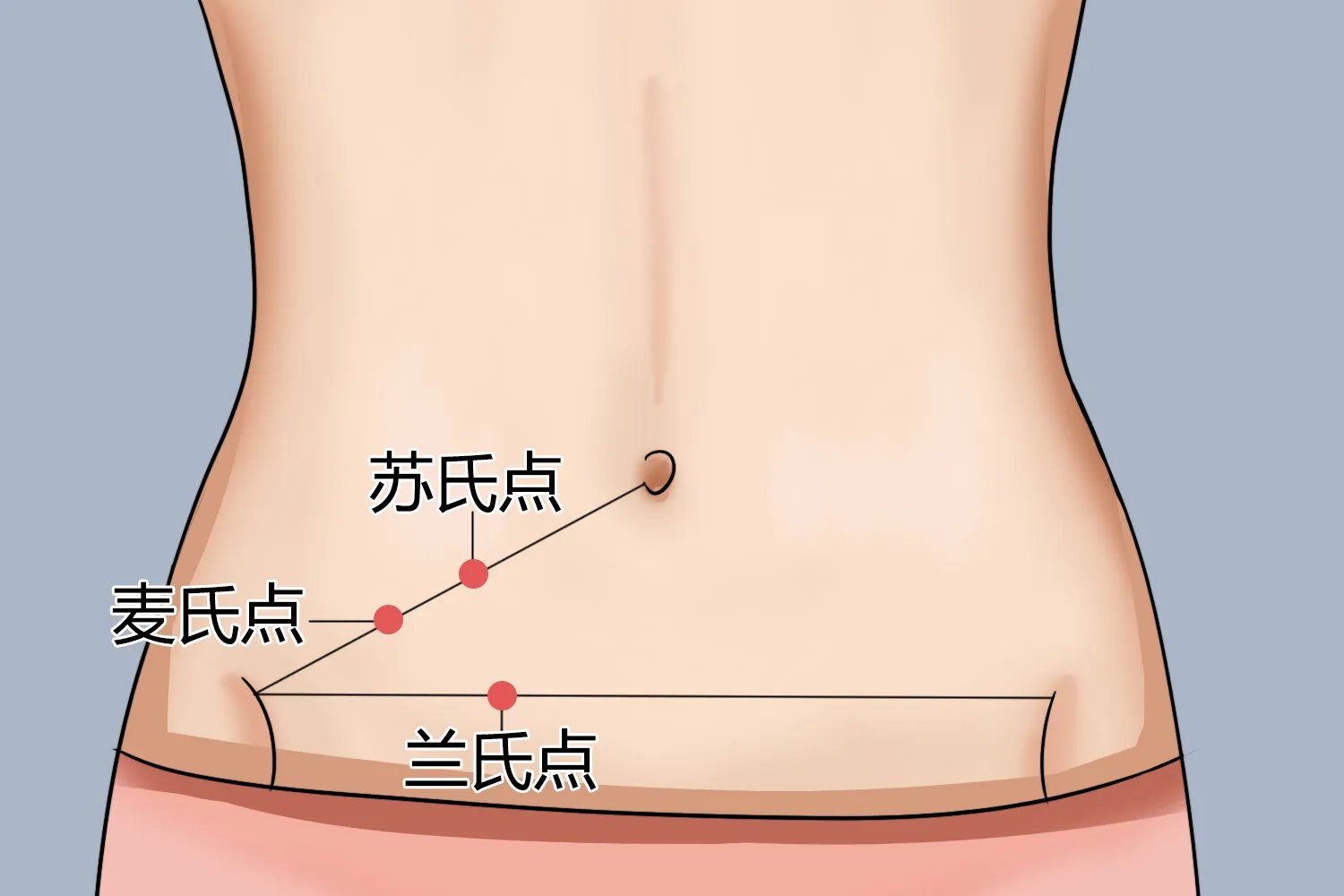 阑尾炎3个压痛点图片