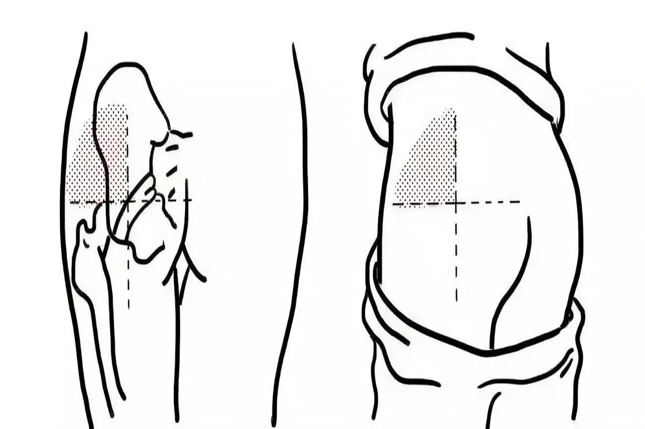 小儿打针部位示意图