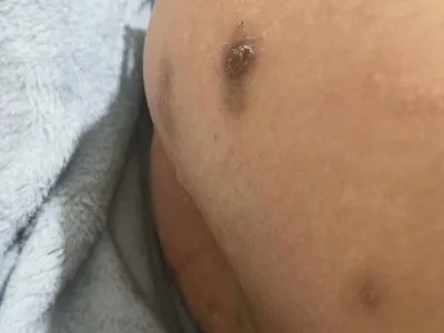 毛囊炎疙瘩图片