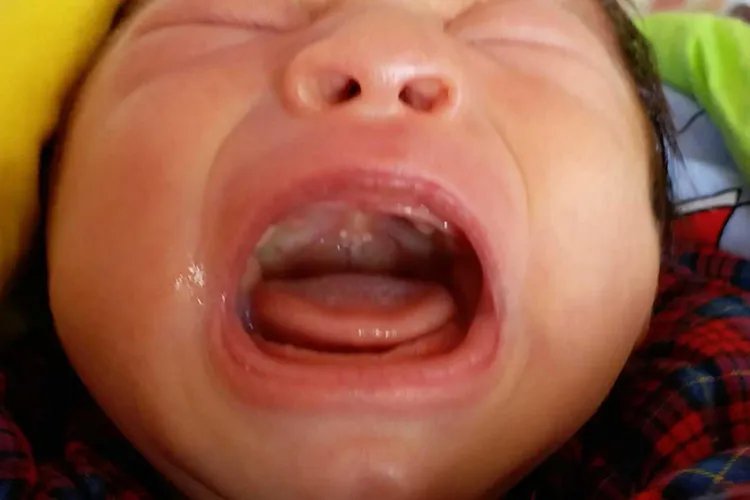 宝宝鹅口疮图片