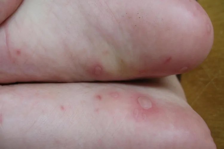 感染手足口病毒图片