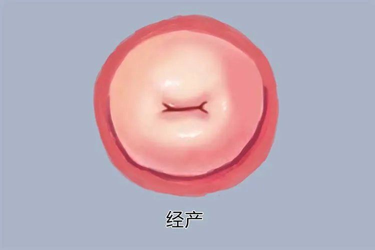 宫颈癌和正常宫颈图片