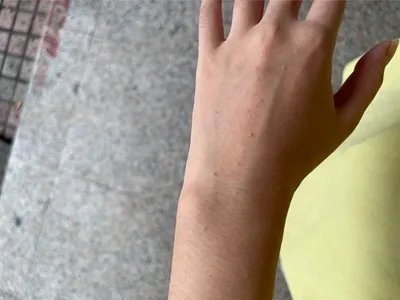 毛囊炎疙瘩图片