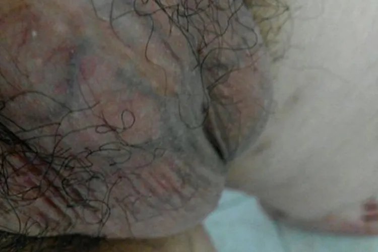 睾丸精索静脉曲张图片真实