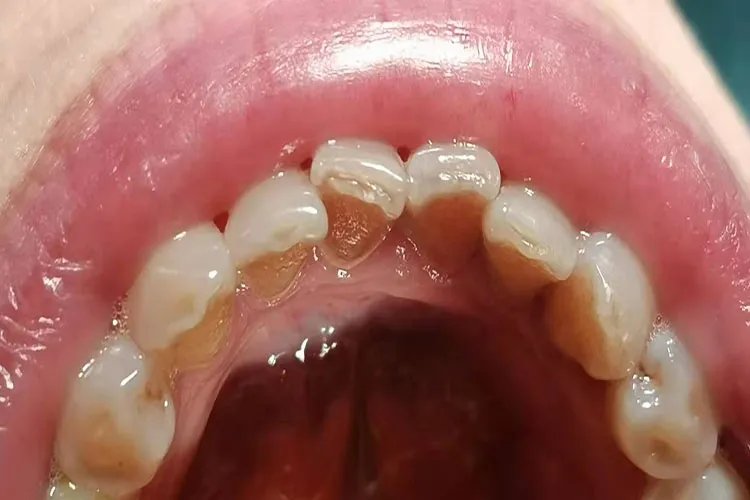 牙垢牙结石图片