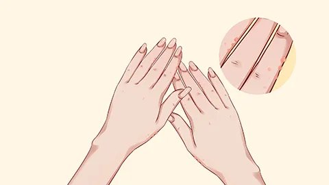 疱疹怎么引起的