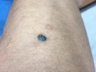 皮内痣黑痣图片