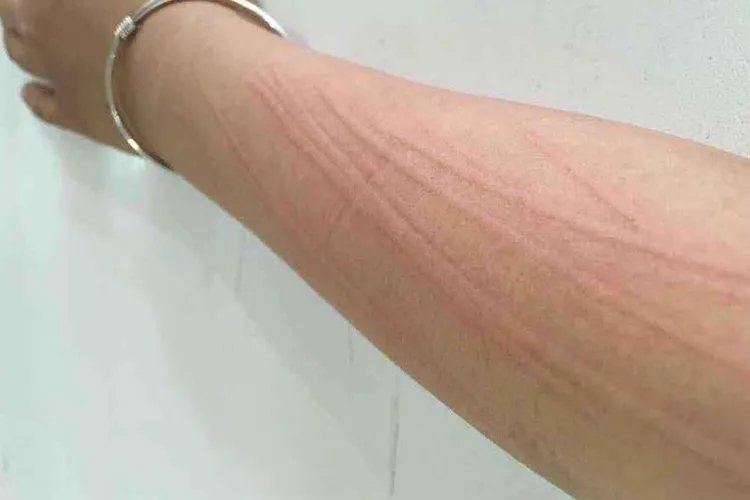 人工性荨麻疹图片和症状