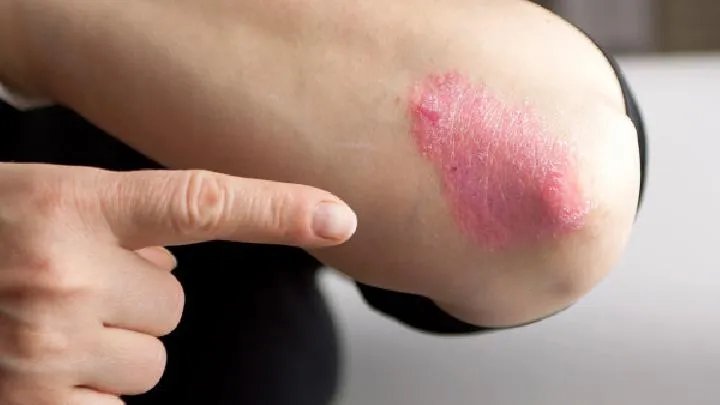 引起牛皮癣的病因都有哪些