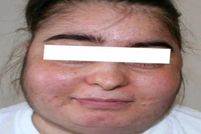 库欣综合征满月脸图片