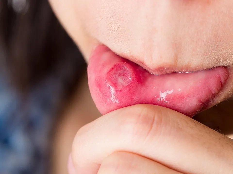 口腔溃疡怎么办? 口腔溃疡怎么治疗?