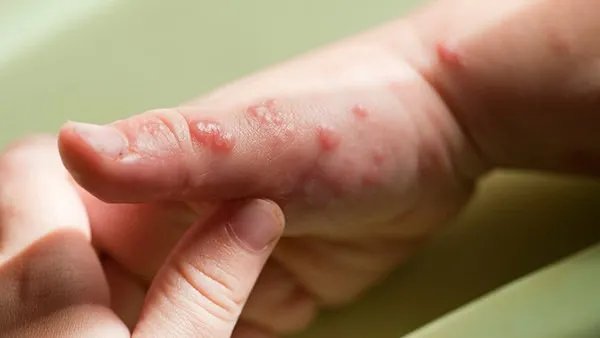 手指脱皮是什么原因?听医生讲