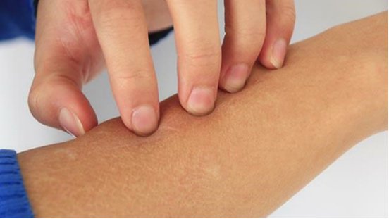 皮肤蝇蛆病是怎么回事