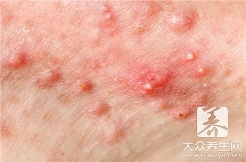 粉刺瘤扎破挤出能好吗