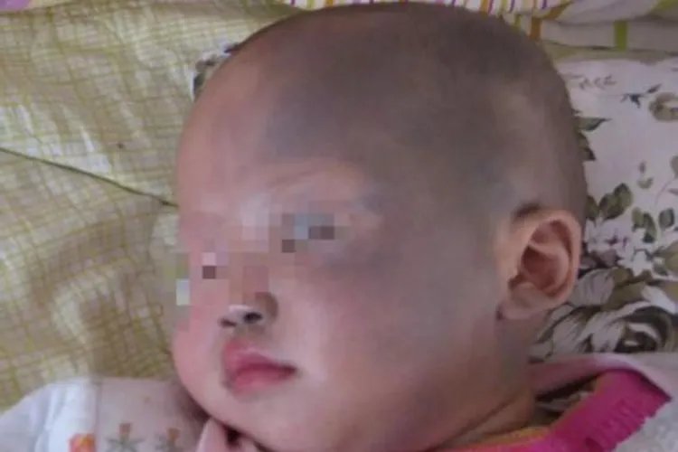 婴儿头顶有青色胎记图片