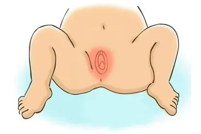 女婴外阴红肿图片