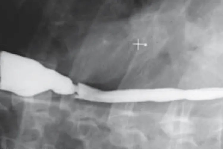 反流性食管炎症状表现