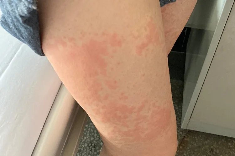 皮炎的10种症状图片