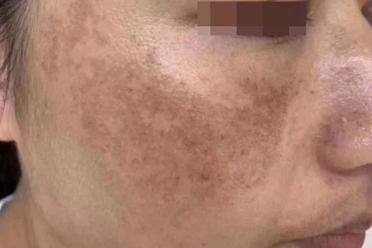 黄褐斑二十种斑图片