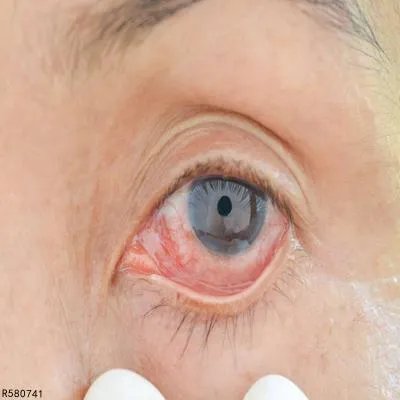 细菌性结膜炎如何预防 三招可预防细菌性结膜炎