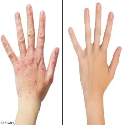 风湿类风湿偏方秘方大全  帮助大家有效解决疼痛