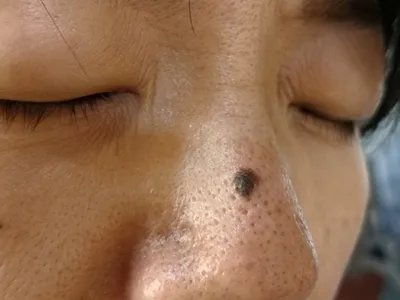 皮内痣黑痣图片