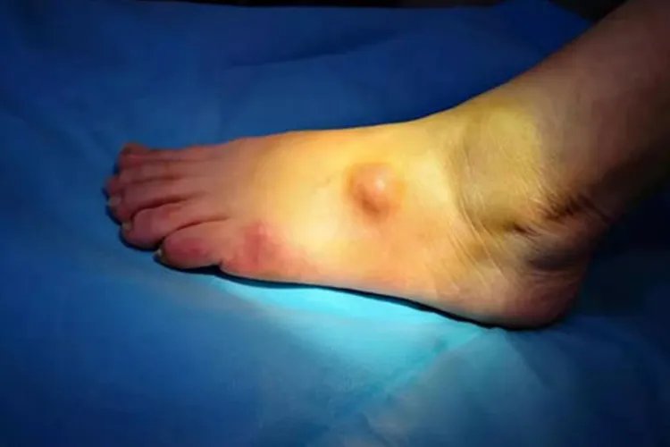 儿童腱鞘囊肿图片