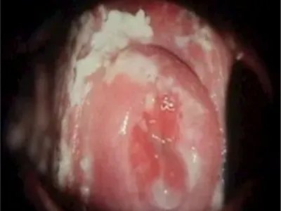 外阴阴道假丝酵母菌病豆腐渣白带图片