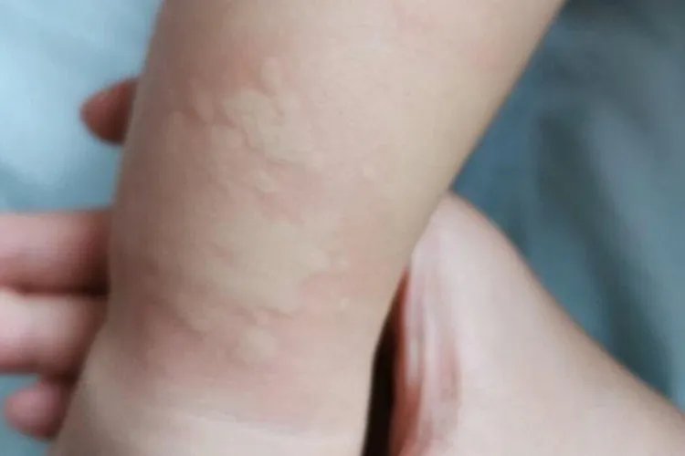 三岁小孩荨麻疹图片