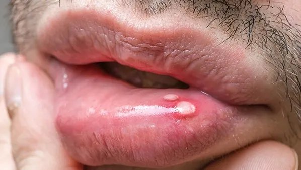 口角疱疹的症状