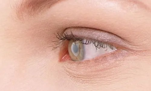 北京双眼皮修复手术价格