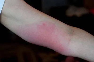 螨虫叮咬后的症状有哪些