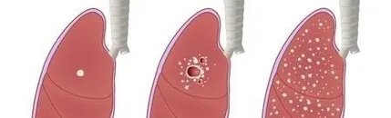 北京胸科医院住院治疗指南