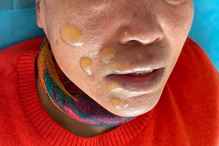 龙传丹症状图片