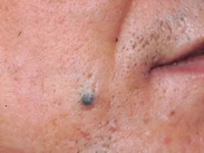 皮内痣黑痣图片
