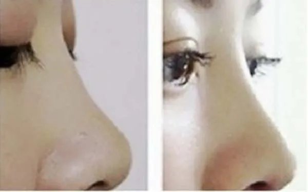 北京哪几家医院做膨体隆鼻好