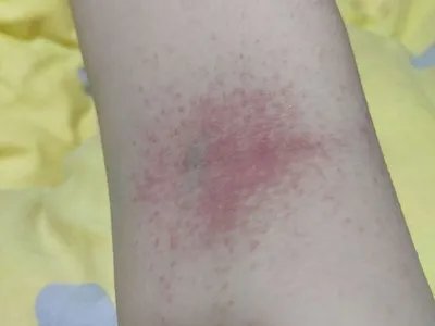 皮肤过敏红肿红点图片