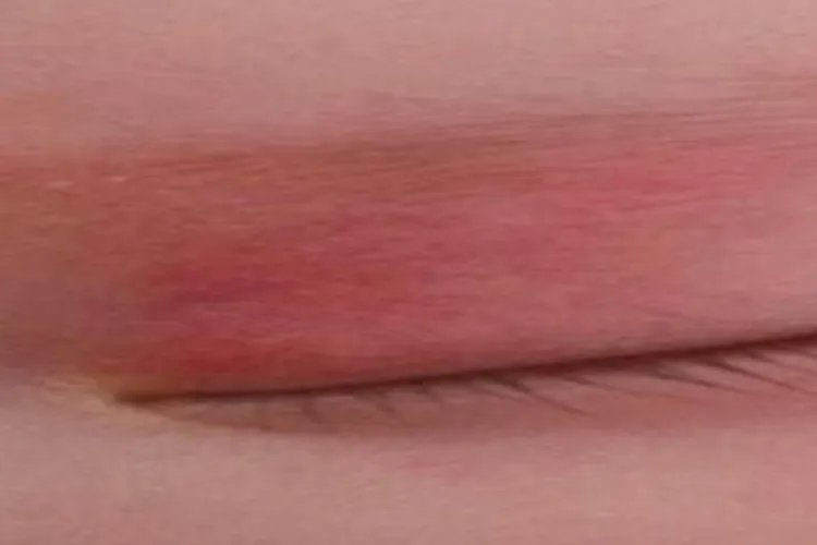 婴儿各种胎记图片