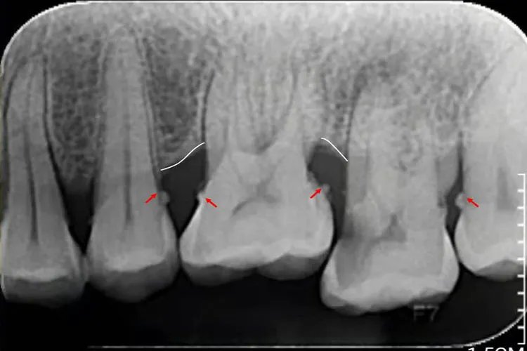 牙垢牙结石图片