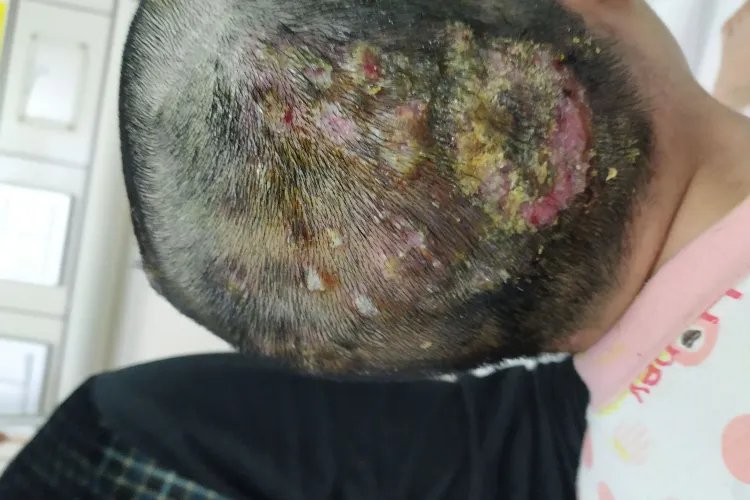 头癣的症状图片