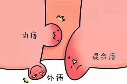 肛门外有个肉疙瘩图片