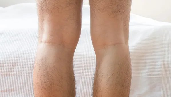 韧带拉伤怎么办