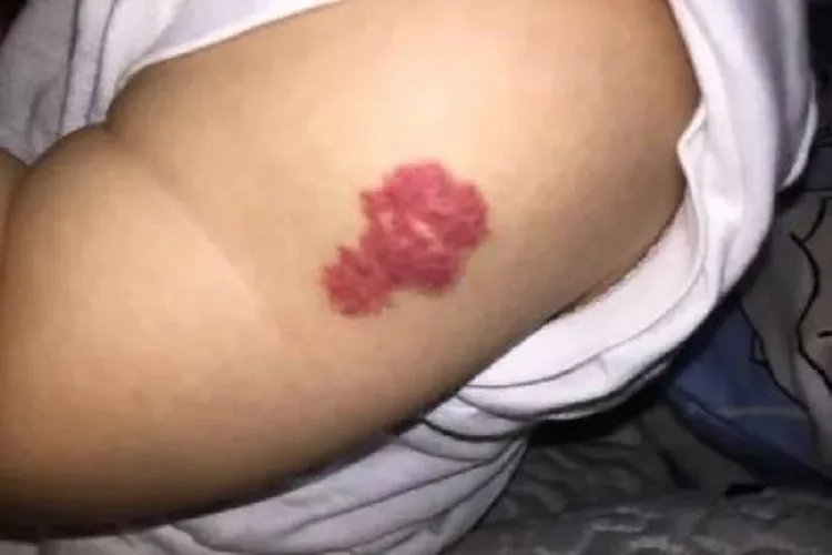 手臂上血管瘤图片