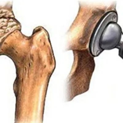 治疗股骨头坏死